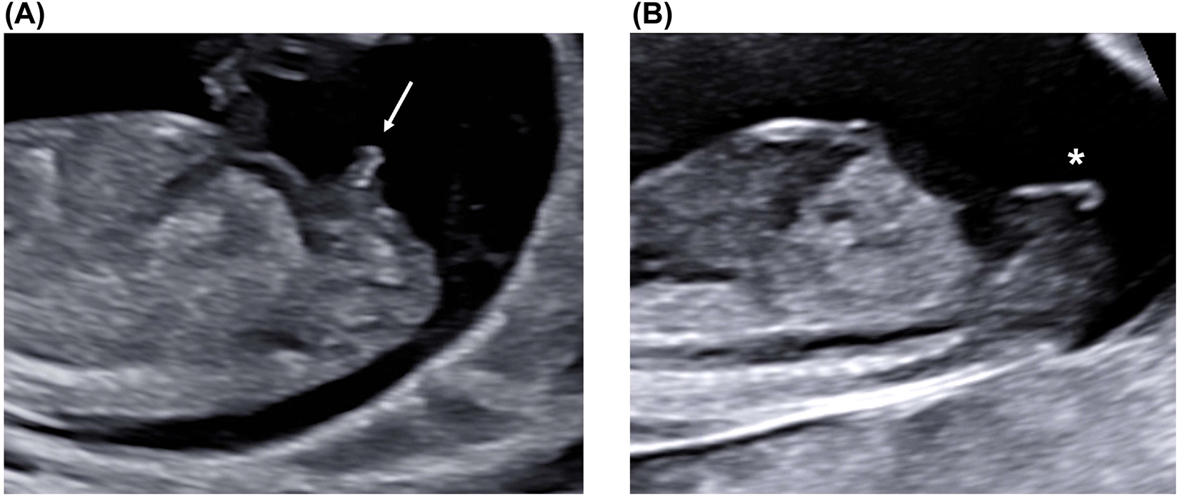 Figure 12: 
Fetal genitalia on the midsagittal view (A) The typical position of a male tuberculus genitalis (arrow), pointing upwards, could be visualized on the anterior surface of the fetal pelvis (B) In female fetuses, the tuberculus appears flat (*).
