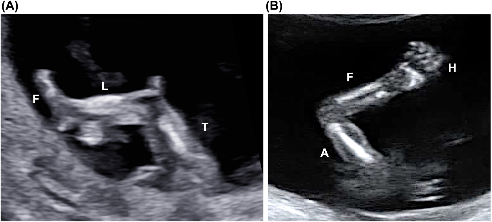 Figure 13: 
Lower (A) and upper (B) limbs. In (A) the tight (T), the leg (L) and the foot (F) are visible. In (B) it is possible to visualize the arm (A), the forearm (F) and the hand (H).
