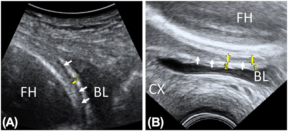 Figure 1: 
Antepartum sonographic measurements of the lower uterine segment. Exemplary transabdominal (A) and transvaginal (B) images. The thickness of the uterine wall in the thinnest part of the LUS was measured in millimeters excluding the wall of the urinary bladder (yellow marker). Arrows mark the uterine wall. Both images from the “histological positive detection of scar tissue” group. Preoperative examinations were performed using the ultrasonic device Voluson E8 (GE Healthcare, Chicago, USA) with a curvex probe (RAB4-8-D, GE Healthcare, Chicago, USA) and an endocavitary probe (RIC6-12-D, GE Healthcare). BL, urinary bladder; CX, cervix; FH, fetal head.
