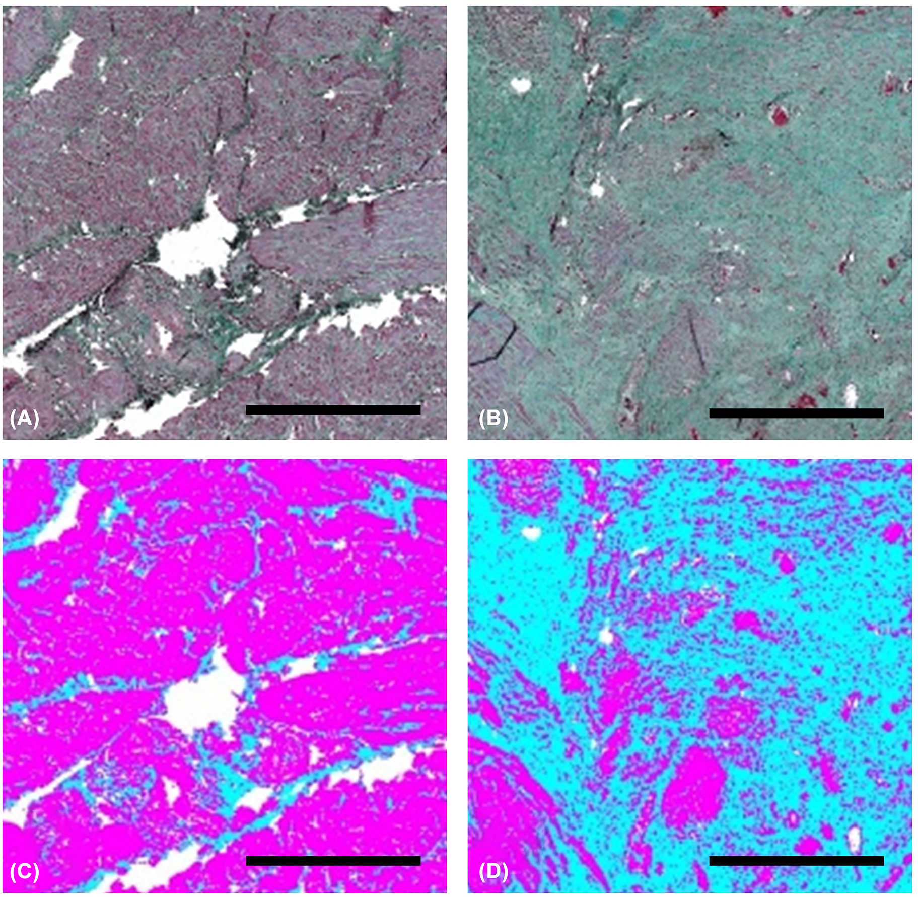 Figure 3: 
Evaluation of histological staining with the software Fiji (NIH, Bethesda, USA) [1]. (A) Exemplary area of unscarred myometrium, (B) Exemplary area of scar tissue, (C) Dichotomized image created with Fiji of the section shown in (A). Muscle tissue is shown in pink, scar tissue in blue. (D) Dichotomized image created with Fiji of the section shown in (B). Muscle tissue is shown in pink, scar tissue in blue. Scale bars=1 mm.
