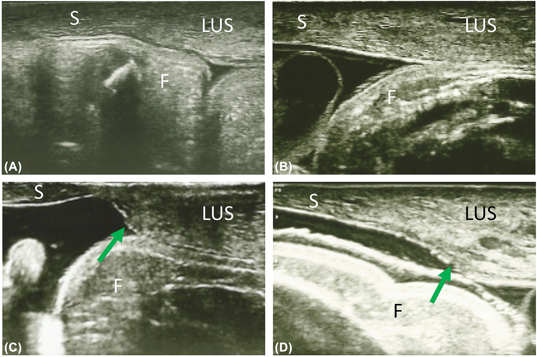 Figure 4: 
Example intraoperative images of the lower uterine segment. While some lower uterine segments get gradually thinner towards the uterine scar (A, B), others have an edge-like transition to the scar (C, D). The arrows mark the edge between the scarred LUS on the left and the unscarred uterine wall on the right. The transducer was placed sagitally on the uterus, the left side of the images corresponds to the caudal end of the transducer. F, fetus; LUS, lower uterine segment; S, uterine scar.
