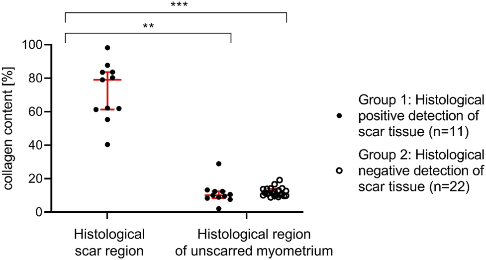 Figure 5: 
Collagen content of uterine wall specimens as determined with imaging software Fiji to analyze tissue sections stained with Gomori Trichrome. Histological scar areas in group 1 contained 63.4% (48.8–72.0) collagen. The unscarred myometrium of the same samples contained 13.0% (6.6–17.2) collagen. The 22 samples from group 2 contained 5.6% (3.0–8.8) collagen and no histological scar region. Data presented as median ± interquartile range. **, p-value<0.01; ***, p-value<0.001.
