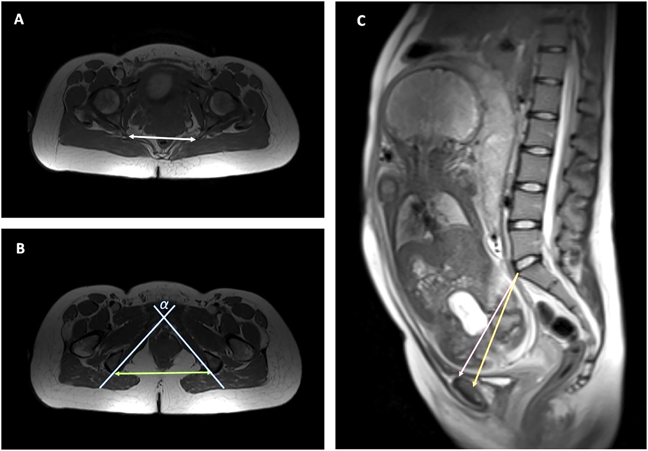 Figure 2: 
Axial and sagittal measurements of the maternal pelvis. (A) Axial view of the maternal pelvis, measurement of interspinous distance (white double arrow), (B) axial view of the maternal pelvis, measurement of intertuberous distance (green double arrow) and pubic angle (α) (blue lines), (C) measurement of obstetrical (pink) and true conjugate (orange).

