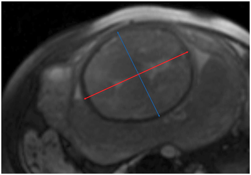 Figure 3: 
Fetometry of the head. Axial view of the fetal head, measurement of biparietal (blue double arrow) and occipitofrontal diameter (red double arrow) at the level of the thalami and cavum septi pellucidi.
