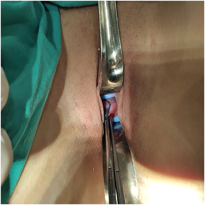 Figure 2: 
The pessary is pushed forward over the shafts of the ring forceps into the vagina and placed firmly around the cervix.
