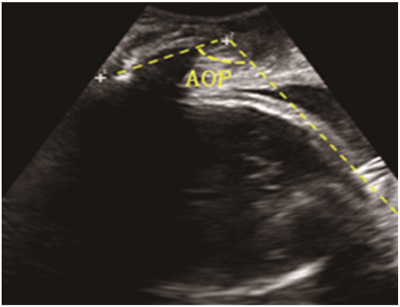 Figure 2: 
The standard image of angle of progression.
