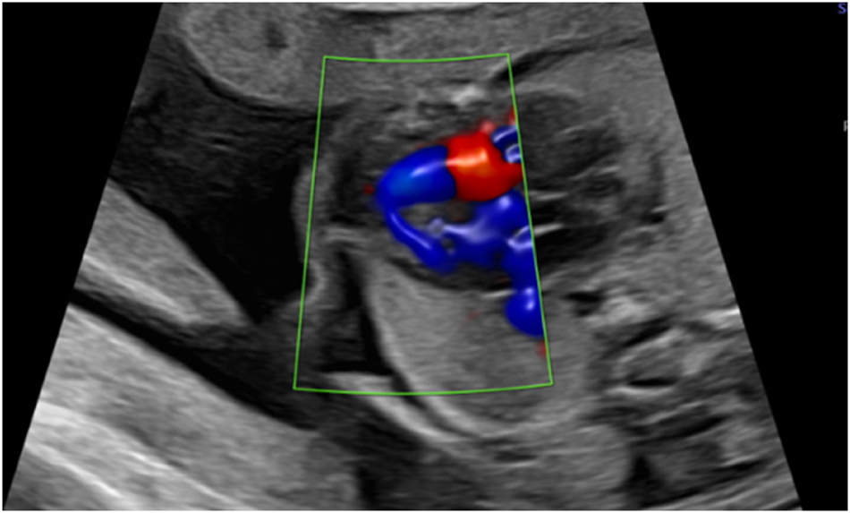 Figure 1: 
Apical ventricular septal defect in 26 weeks.
