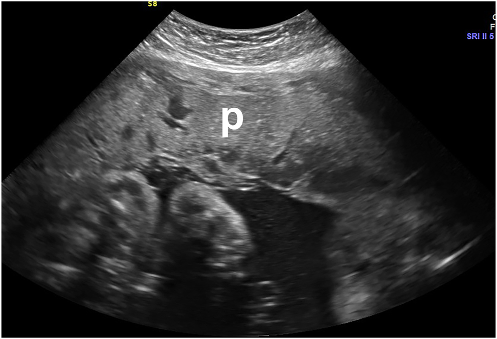 Figure 1:
Thickened heterogeneous placenta (p) in a symptomatic patient who presented with bleeding and contractions, representing an intraplacental hemorrhage. This met the clinical criteria for abruption. Abruption was confirmed on placental examination and pathology after birth.