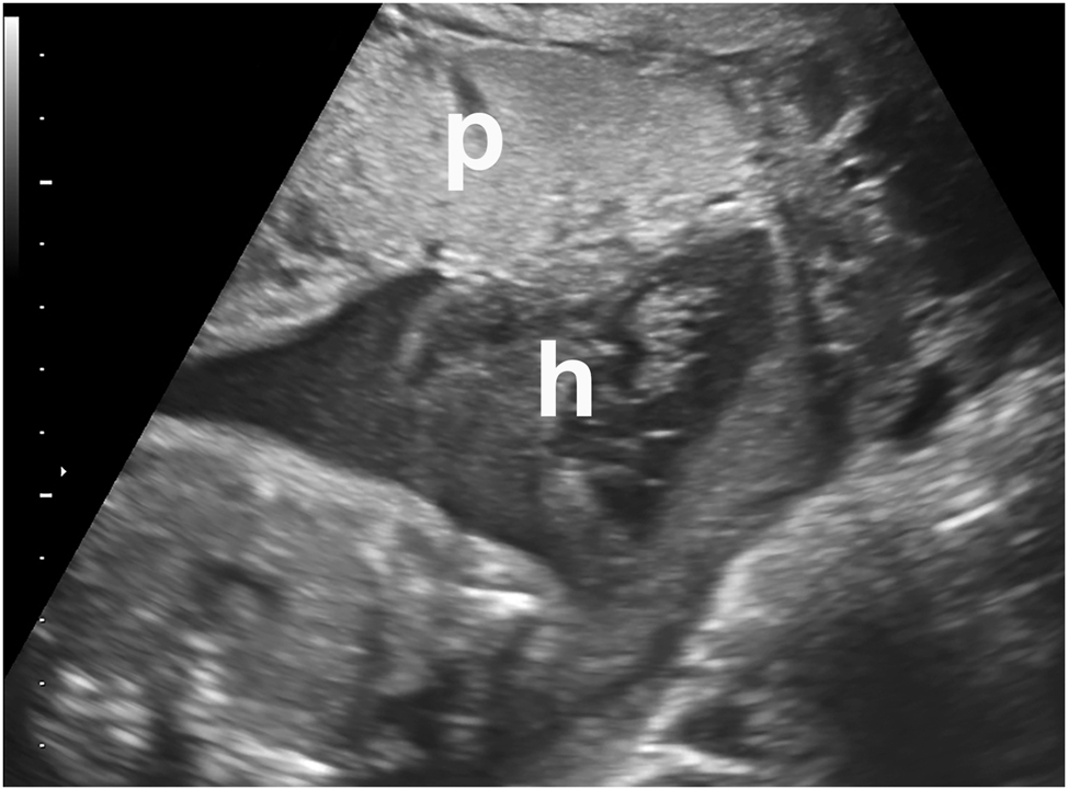 Figure 3:
Intraamniotic hematoma (h) in a symptomatic patient who presented with bleeding and contractions. Placenta=“p” This met the clinical criteria for abruption. Abruption was confirmed on placental examination and pathology after birth.