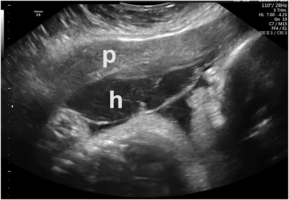 Figure 6:
Preplacental hematoma in an asymptomatic patient. Placenta=“p”. Hematoma=“h”. Abruption was confirmed at delivery.