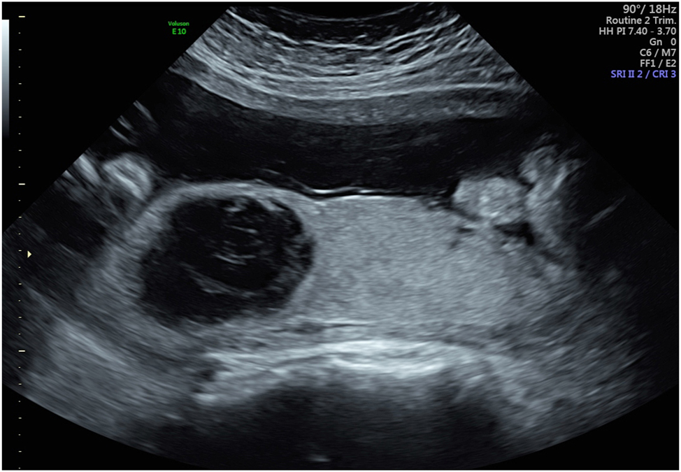 Figure 9:
Large rounded intraplacental hematoma in a patient with preeclampsia at 32 weeks who was otherwise asymptomatic. A week later, the patient had a massive clinical abruption requiring urgent cesarean delivery. Placental pathology confirmed a 60 % placental abruption.