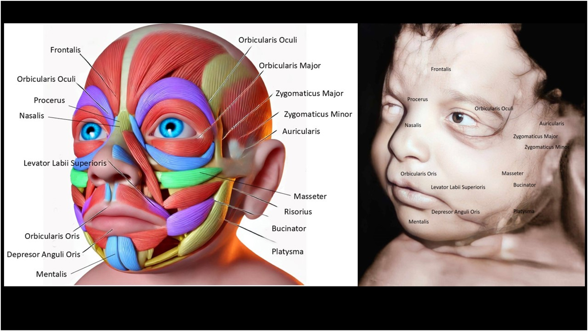 Figure 3: 
The image contrasts the detailed anatomy of fetal facial muscles (left) with a 4D ultrasound of a fetal face (right), showing muscles like Orbicularis Oculi and Zygomaticus Major. The ultrasound reveals a neutral facial expression, reflecting developing muscle coordination and symmetry. Assessing the fetal face helps detect congenital issues like cleft lip or muscular defects and provides insights into neurological health. This enables early diagnosis, intervention, and reassures parents of healthy fetal development.
