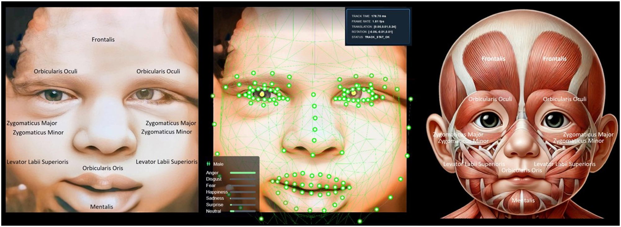 Figure 7: 
The image displays a 4D ultrasound view of a baby’s face (left), AI facial tracking analyzing expressions (middle), and fetal facial muscle anatomy (right). The expression shown appears neutral, driven by muscle activity in areas like the Zygomaticus Major and Orbicularis Oris, reflecting neuromuscular coordination rather than emotional realization. Understanding fetal facial conditions is vital for detecting abnormalities like cleft lip and assessing neurological and muscular development. AI facial tracking offers precise, automated evaluation of muscle and nerve functions, helping identify potential developmental issues early. While it does not confirm emotional realization, it reflects the functionality of facial muscles and nerves. This technology supports timely medical interventions and reassures parents about the fetus’s health and development.
