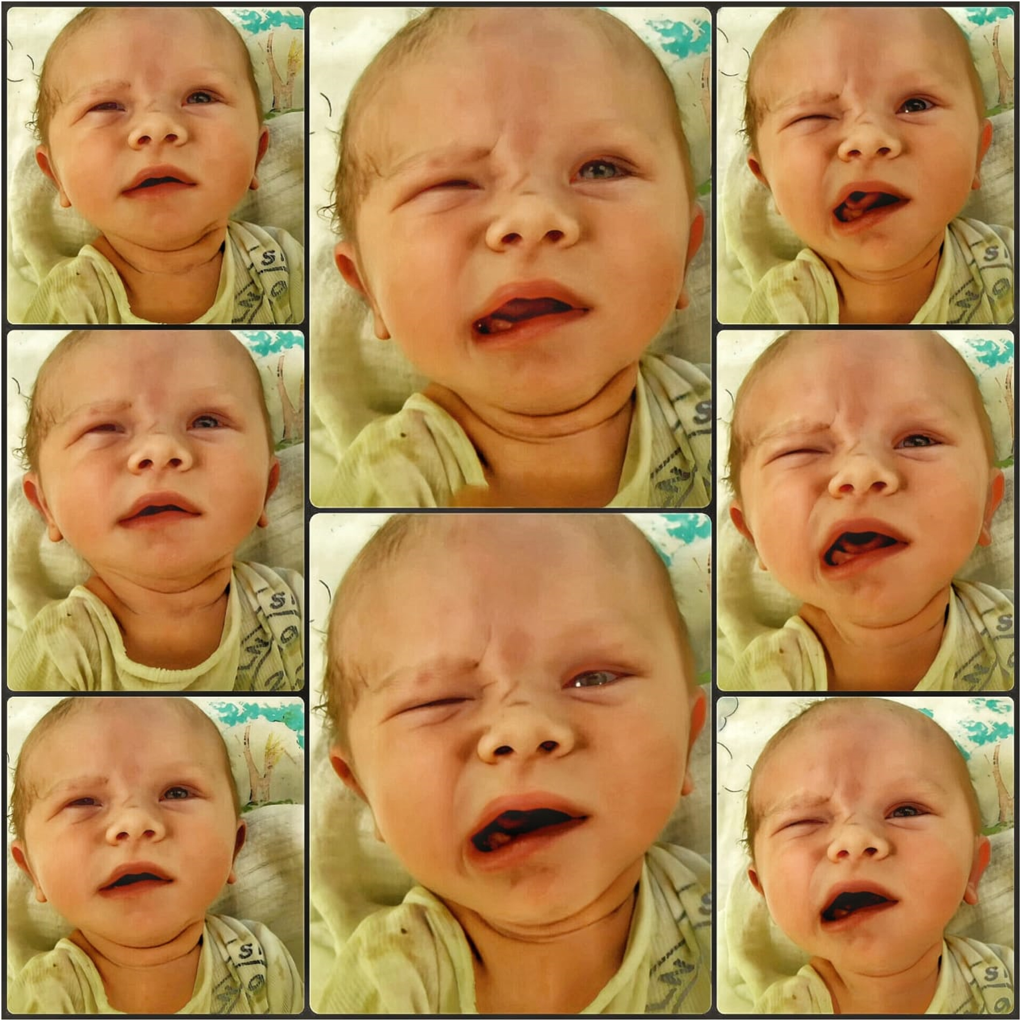 Figure 10: 
The image depicts a 7-day-old baby with asymmetrical mouth movements during crying, caused by trauma during vaginal delivery. The paralysis affects facial expressions like symmetrical crying and smiling, involving muscles like Orbicularis Oris and Zygomaticus Major. Detecting facial asymmetry in the womb can help anticipate potential delivery-related trauma or neuromuscular issues. 4D ultrasound provides detailed imaging but has limitations in predicting functional issues like muscle paralysis, as these often develop dynamically post-birth. The asymmetry seen here likely results from birth trauma or nerve compression, not congenital Bell’s palsy. However, rare cases of fetal asymmetry on ultrasound could indicate congenital nerve issues requiring postnatal evaluation. Combining prenatal imaging with follow-up assessments is crucial to distinguish between temporary trauma and lasting neuromuscular disorders.
