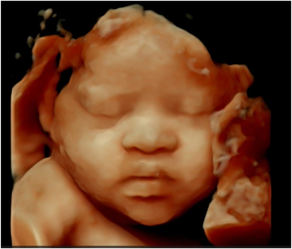 Figure 6:
This 4D ultrasound image displays facial features characteristic of Down syndrome, such as a flattened facial profile and midfacial hypoplasia; although precise measurement ranges are not provided, the image is intended to serve as a reference for clinicians in identifying these anomalies, with explanatory notes emphasizing the need for clinical correlation.
