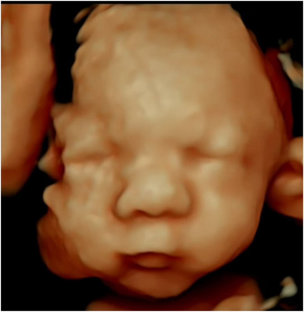 Figure 7:
This Figure shows a 4D ultrasound image highlighting key features of Edwards syndrome, including a prominent occiput, micrognathia, and craniofacial asymmetry; while no standardized normal ranges exist for these features, the image offers a diagnostic reference and includes notes on their clinical relevance.