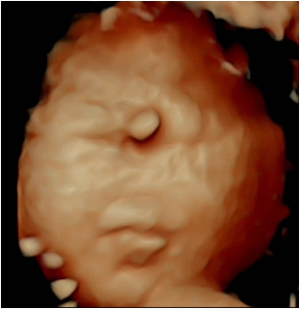Figure 8:
This 4D ultrasound image reveals distinct craniofacial anomalies characteristic of Patau’s syndrome (Trisomy 13), offering valuable insights for prenatal diagnosis. Prominent features, such as holoprosencephaly (incomplete brain division), cleft lip or palate, and hypotelorism (close-set eyes), are visualized in high resolution, with the image serving as an illustrative guide for diagnosis. The advanced imaging allows for detailed assessment of facial malformations, which are key diagnostic markers of this condition. By providing a comprehensive view, this technique enhances early detection and enables better-informed clinical decisions and family counselling.