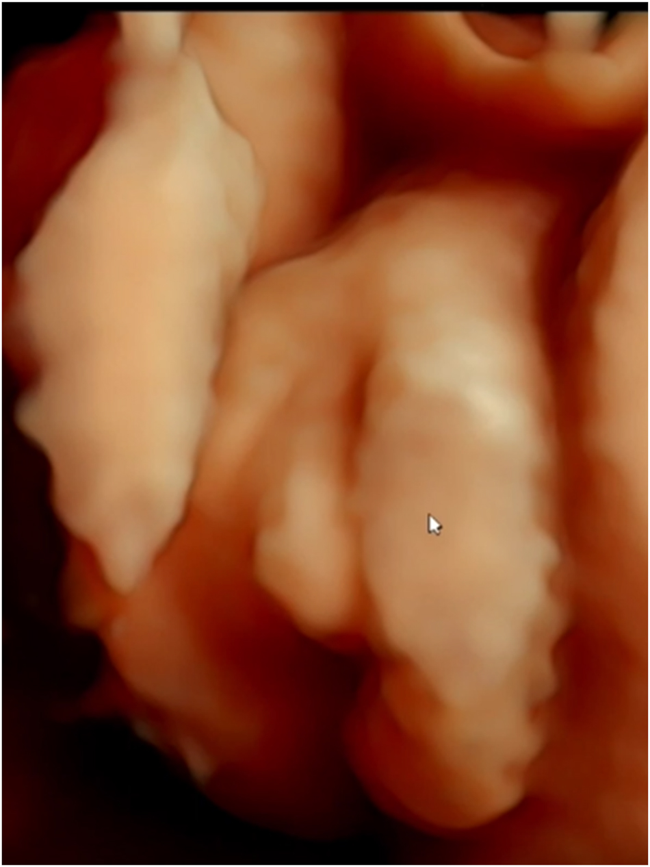 Figure 9:
The 47 XXX syndrome, also known as Trisomy X, is a chromosomal condition that affects females and arises from the presence of an extra X chromosome in each cell. While many individuals with this condition have normal physical development and fertility, some may experience taller stature, learning disabilities, and delayed speech or motor skills. The condition is typically diagnosed through genetic testing, and most affected individuals lead healthy lives with appropriate support for any developmental challenges.
