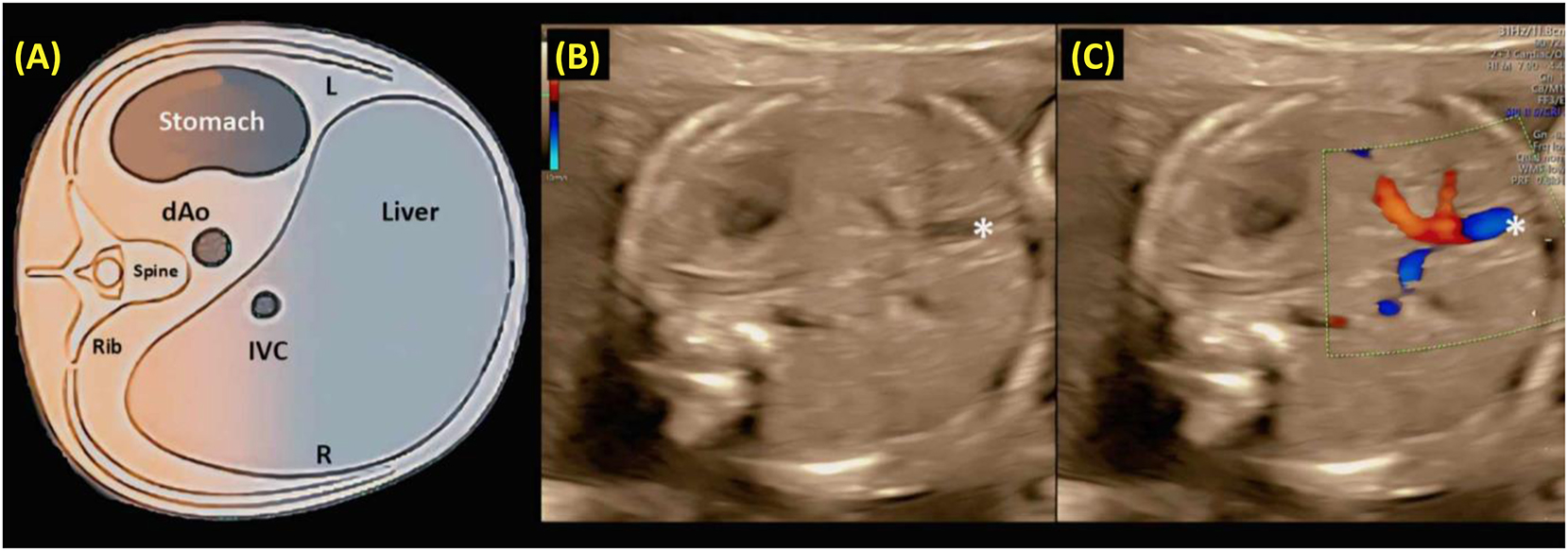 Figure 9: 
A schematic diagram (a), along with grayscale (b) and color Doppler (c) ultrasound images, depicting an axial view of the fetal upper abdomen. (A) The transverse view of the fetal abdomen is used to assess abdominal situs. After establishing fetal laterality based on the position in utero, the stomach should be observed on the left side of the fetus, while the descending aorta (dAo) and inferior vena cava (IVC) are located to the left and right of the spine, respectively. (B, C) A short segment of the umbilical vein (*) is visible in the center of the liver. L and R indicate left and right [3], [4], [5, 9], 11], 17], 24], 65], 66].

