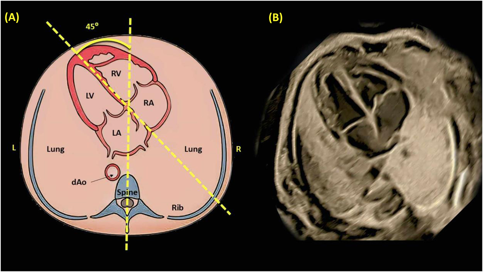 Figure 10: 
Illustrates the determination of cardiac position and axis through a schematic diagram (A) and a corresponding grayscale ultrasound image (B). An imaginary line is drawn from the spine at the back to the sternum at the front, dividing the thorax into two equal halves, left (L) and right (R). In a normal fetal heart, the majority of the heart is located on the left side, with the cardiac apex oriented towards the left at an angle of 45±20° relative to the anteroposterior axis of the chest. dAo refers to the descending aorta; LA, left atrium; LV, left ventricle; RA, right atrium; and RV, right ventricle [3], [4], [5, 9], 11], 24], 65], 66].
