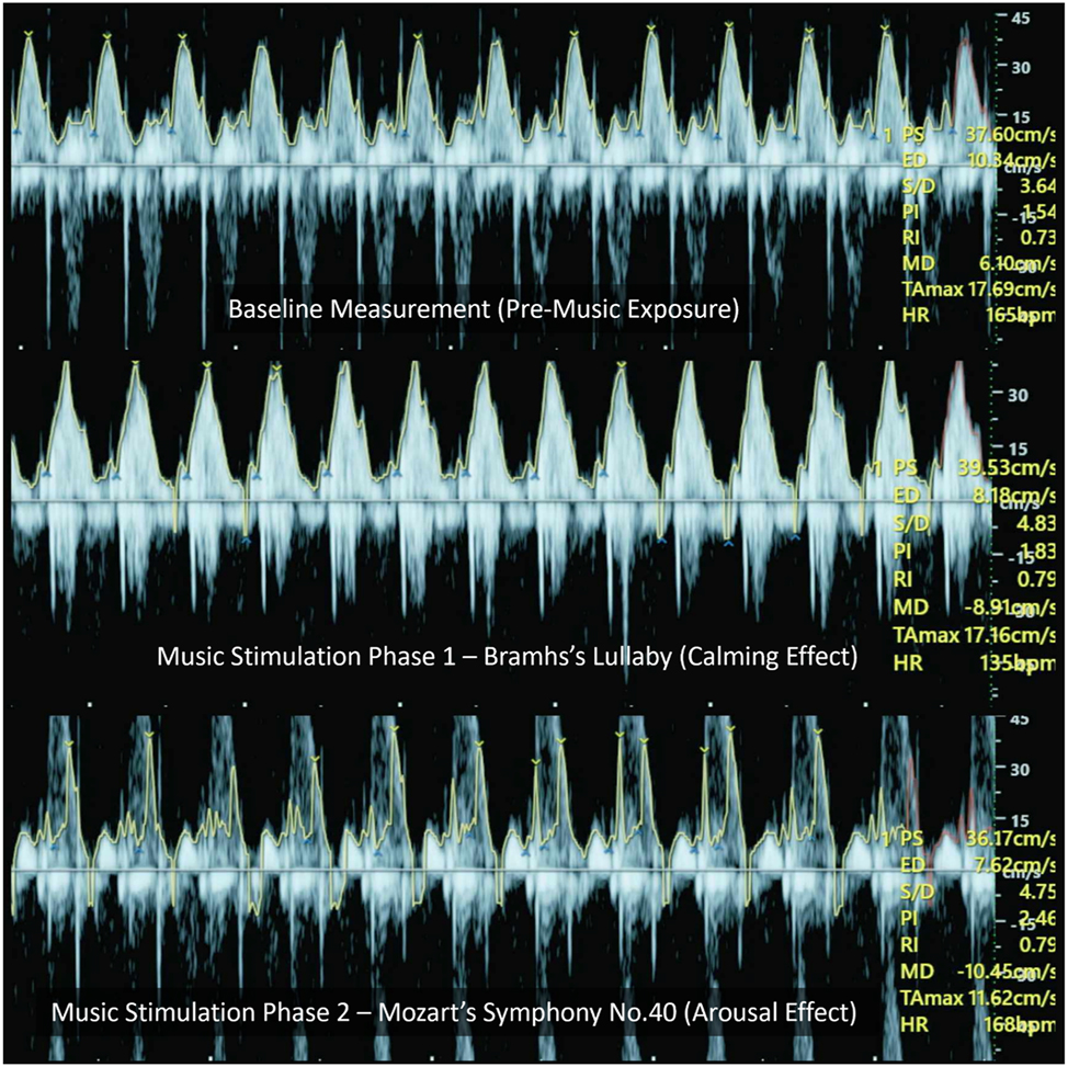 Figure 2:
This Figure presents representative trans-mitral/tricuspid Doppler waveforms recorded under three auditory conditions. Although aliasing artifacts are visible, especially at peak velocities, the E-wave peak velocities (representing early diastolic filling) and time-averaged maximum velocities (TAMax, reflecting average flow envelope) were assessed within each condition. The changes observed across Brahms’ and Mozart’s stimuli reflect alterations in diastolic inflow dynamics, which are consistent with autonomic modulation.