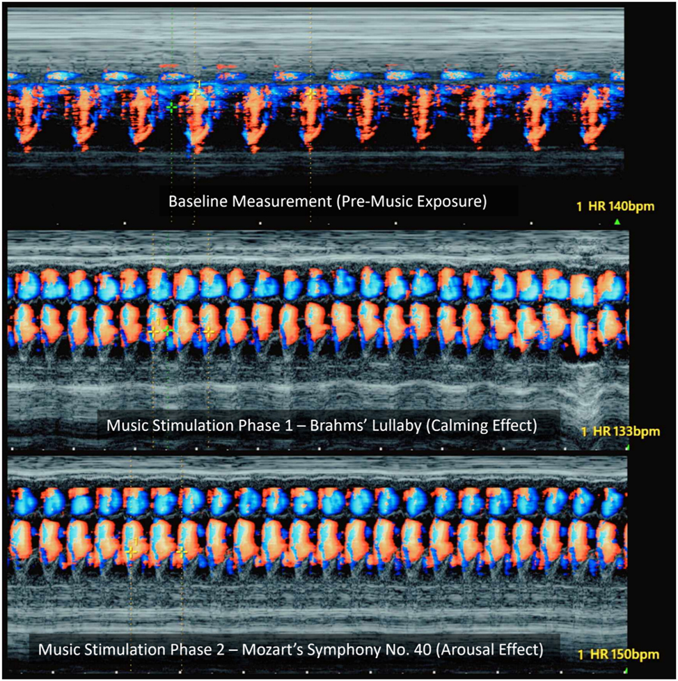 Figure 8:
Color Doppler M-mode imaging of fetal cardiac responses to music stimulation (qualitative visualization only). This Figure presents qualitative M-mode Doppler visualizations of fetal cardiac activity across three auditory conditions: (Top) baseline (pre-music), (middle) Brahms’ Lullaby (calming music), and (Bottom) Mozart’s Symphony no. 40 (stimulating music). These color Doppler M-mode images do not provide precise velocity measurements but are used here to illustrate changes in fetal heart rate (FHR) and Doppler flow intensity. Compared to baseline (∼140 bpm), exposure to Brahms’ Lullaby shows a visible reduction in heart rate (∼133 bpm) and softened Doppler signal intensity, reflecting parasympathetic activation. In contrast, the Mozart condition shows a marked increase in FHR (∼150 bpm) with intensified flow signals, suggestive of sympathetic arousal. These visualizations highlight the temporal and qualitative changes in fetal cardiac function in response to musical stimuli and support the neuromodulatory potential of prenatal auditory therapy.