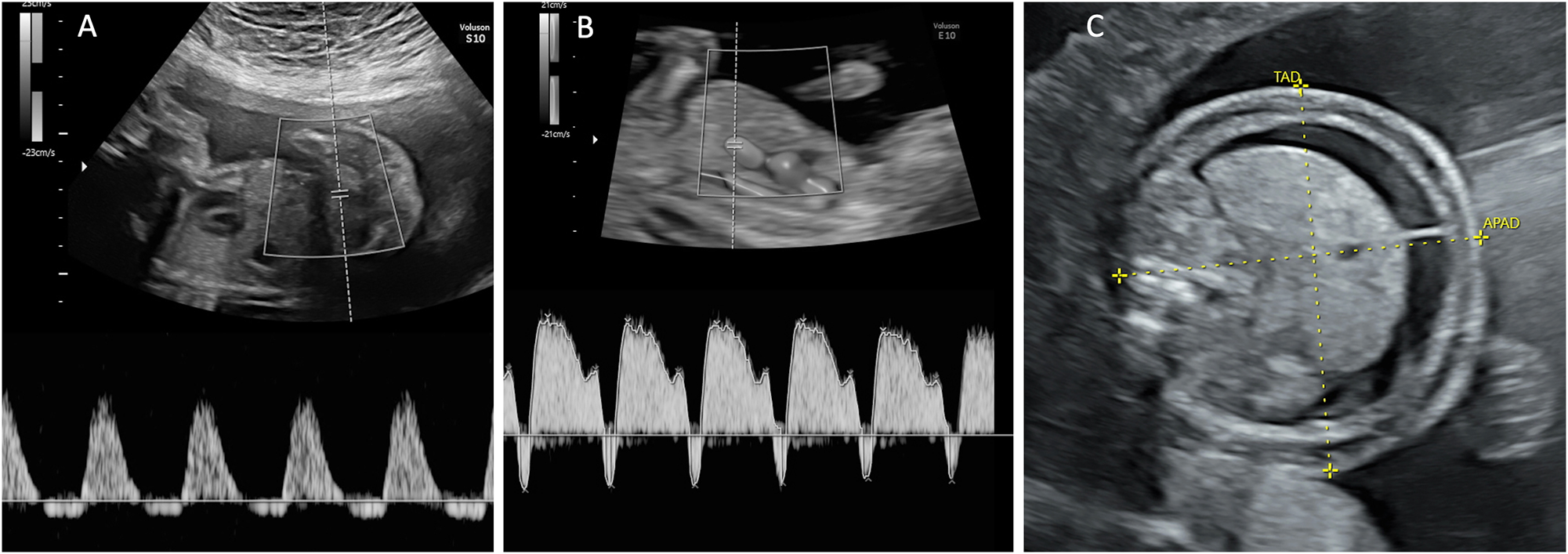 Figure 1: 
Ultrasound findings relevant for TTTS staging. (A) Umbilical artery Doppler with reverse flow in end-diastole and (B) ductus venosus Doppler with reverse a-wave. (C) Hydropic fetus with ascites and skin oedema.