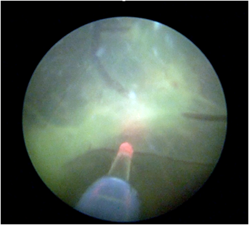 Figure 4: 
Fetoscopic image of the Solomon technique: continuous laser ablation along the vascular equator.