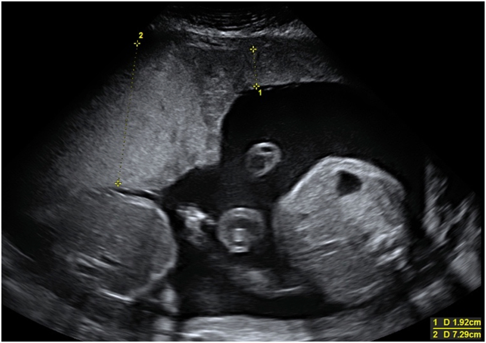 Figure 5: 
In TAPS, the donor’s placental share appears hyperechoic and thick, while the recipient’s placental share is hypoechoic and thin.