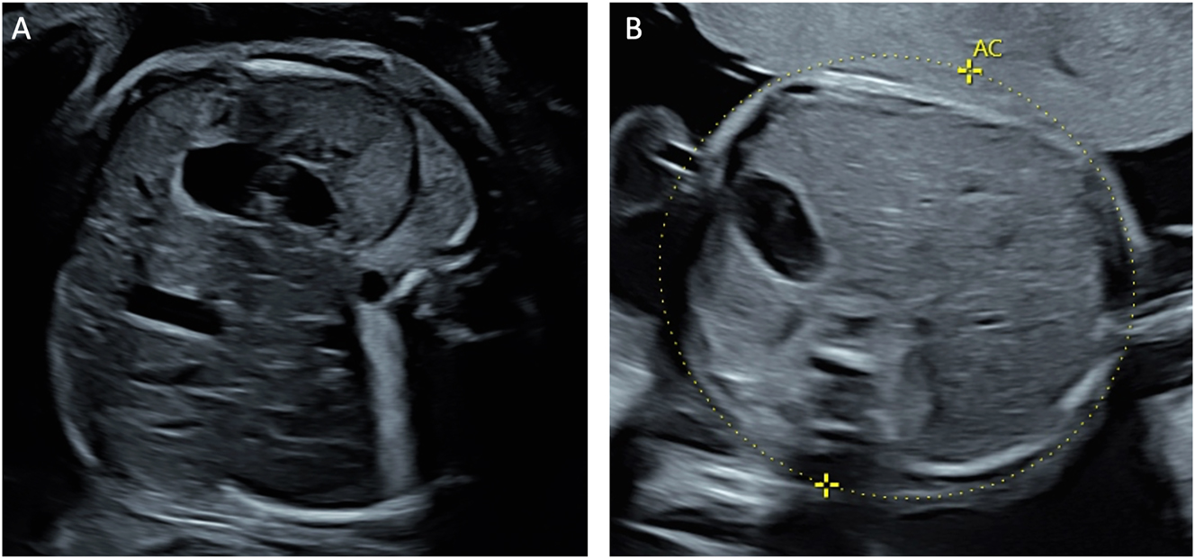 Figure 6: 
Ultrasound appearance of the liver in twin-to-twin transfusion syndrome. (A) Abdomen of the polycythemic recipient twin showing hypoechoic liver parenchyma with hyperechoic portal venous walls, known as the ‘starry-sky’ liver appearance, and (B) the abdomen with the normal liver of the anemic donor twin.