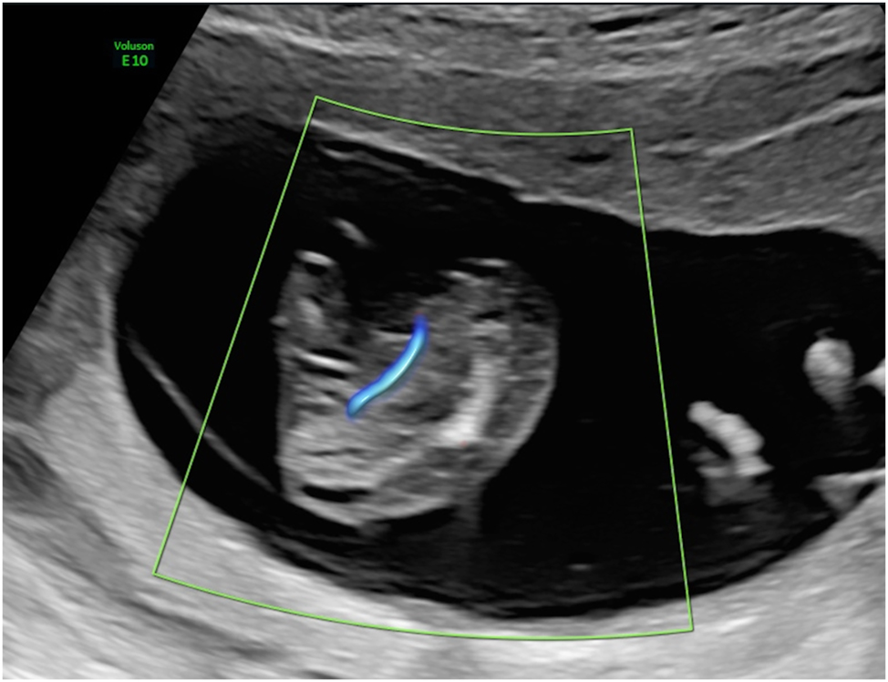 Figure 7: 
Parasitic twin (acardius acranius) with absent heart and head, and retrograde umbilical artery perfusion.