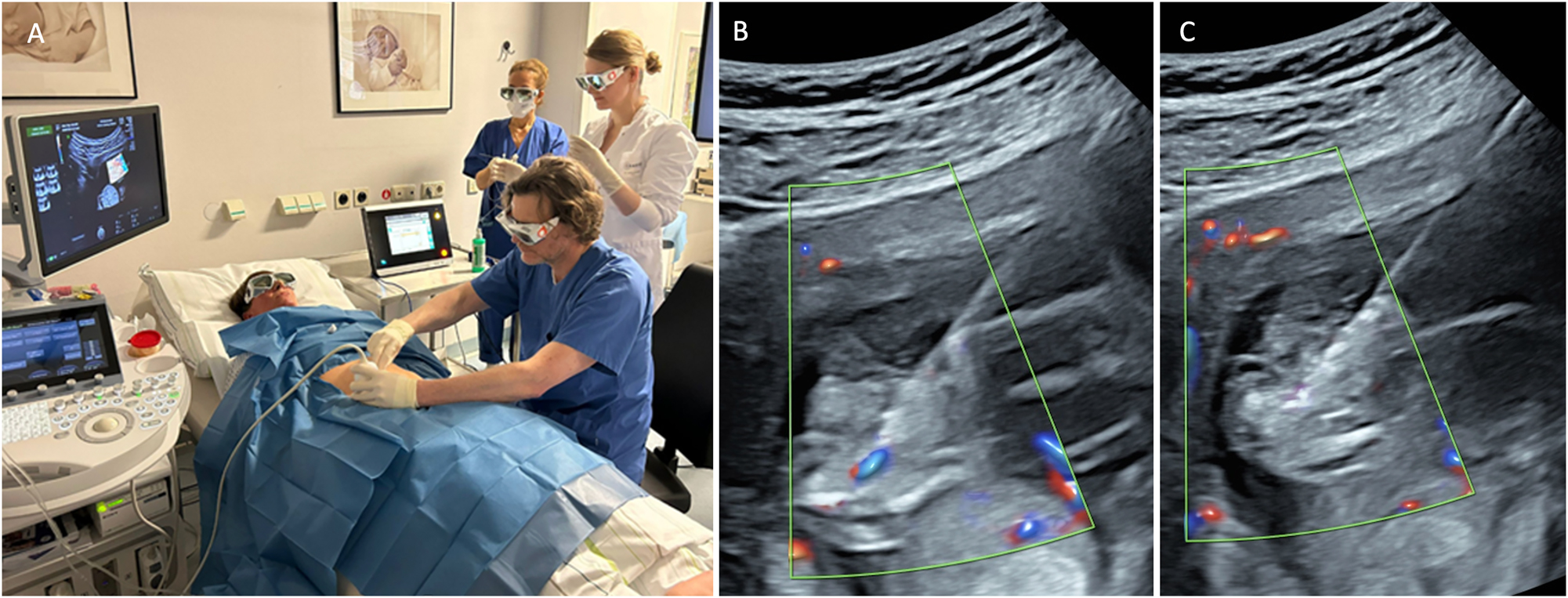 Figure 8: 
Intrafetal laser therapy performed in the first trimester (A) procedural setup. (B) Ultrasound-guided insertion of an 18-gauge needle into the parasitic twin at the level of the pelvic region, targeting its vascularization. (C) Laser fiber insertion through the needle for coagulation of the vessel, resulting in complete occlusion.