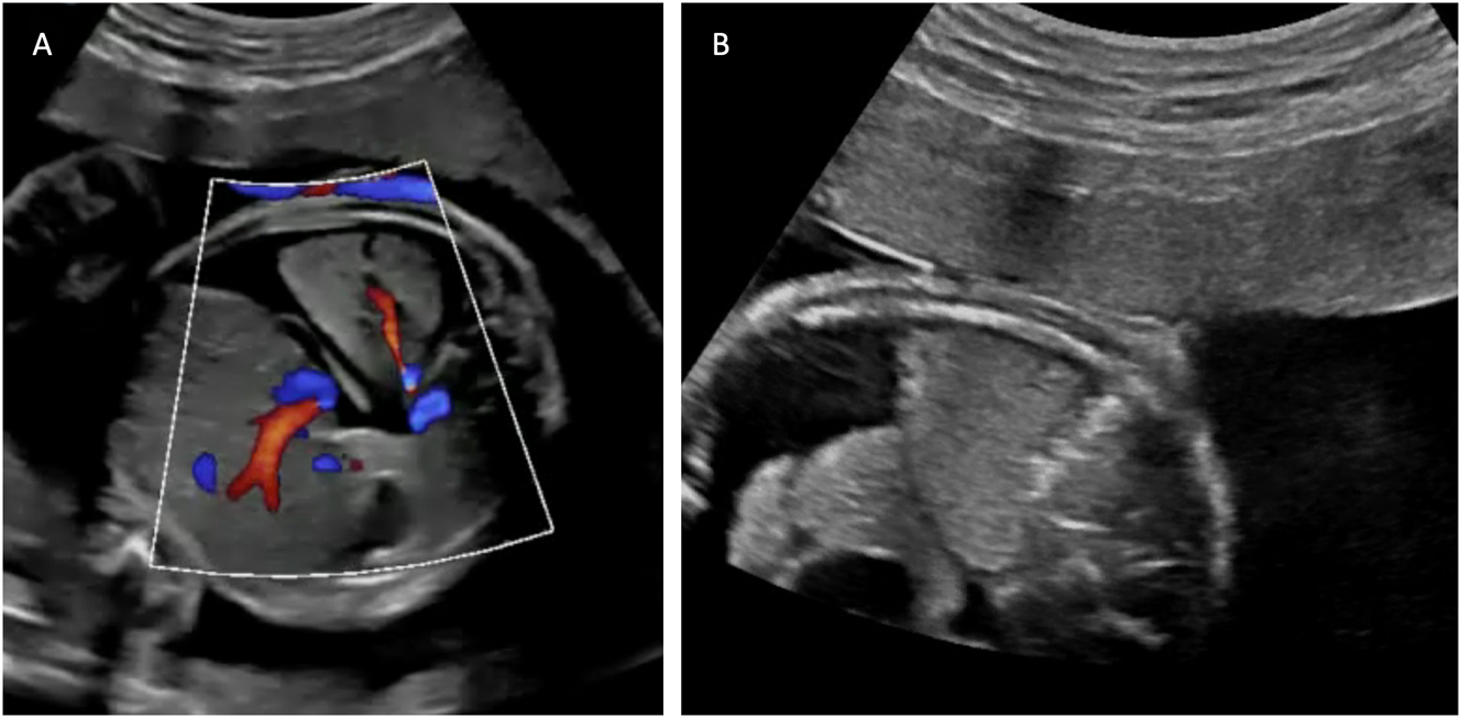 Figure 9: 
Ultrasound images depicting bronchopulmonary sequestration and its management. (A) Transverse thoracic view showing bronchopulmonary sequestration with aortic perfusion and fetal hydrops. (B) Intrafetal laser coagulation of the feeding vessel using a laser fiber inserted through an 18-gauge needle under ultrasound guidance. Courtesy of Prof. Dr. Ingo Gottschalk.