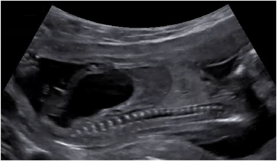 Figure 10: 
Sagittal view of a fetus with an enlarged bladder due to lower urinary tract obstruction (LUTO) caused by posterior urethral valves.