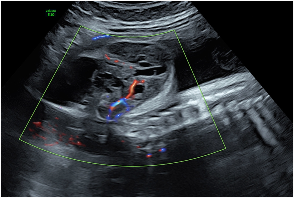 Figure 11: 
Sagittal view of a fetus with a sacrococcygeal teratoma demonstrating a feeding vessel suitable for laser ablation.