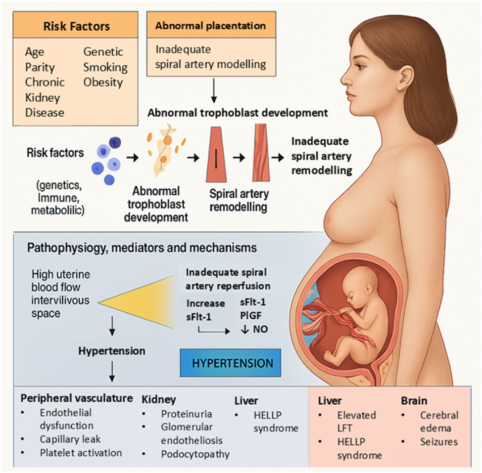 Figure 1: 
This Figure summarizes the modern pathophysiology of preeclampsia, starting from maternal and environmental risk factors leading to abnormal placentation. Impaired trophoblast development and inadequate spiral artery remodeling result in placental ischemia and hypoxia. These changes trigger an angiogenic imbalance, marked by elevated sFlt-1, reduced PlGF, and decreased nitric oxide (NO), causing widespread endothelial dysfunction. The resulting systemic manifestations include hypertension, proteinuria, glomerular endotheliosis, HELLP syndrome, cerebral edema, and seizures. This integrative model highlights the key molecular pathways linking placental dysfunction to multi-organ maternal injury in preeclampsia.