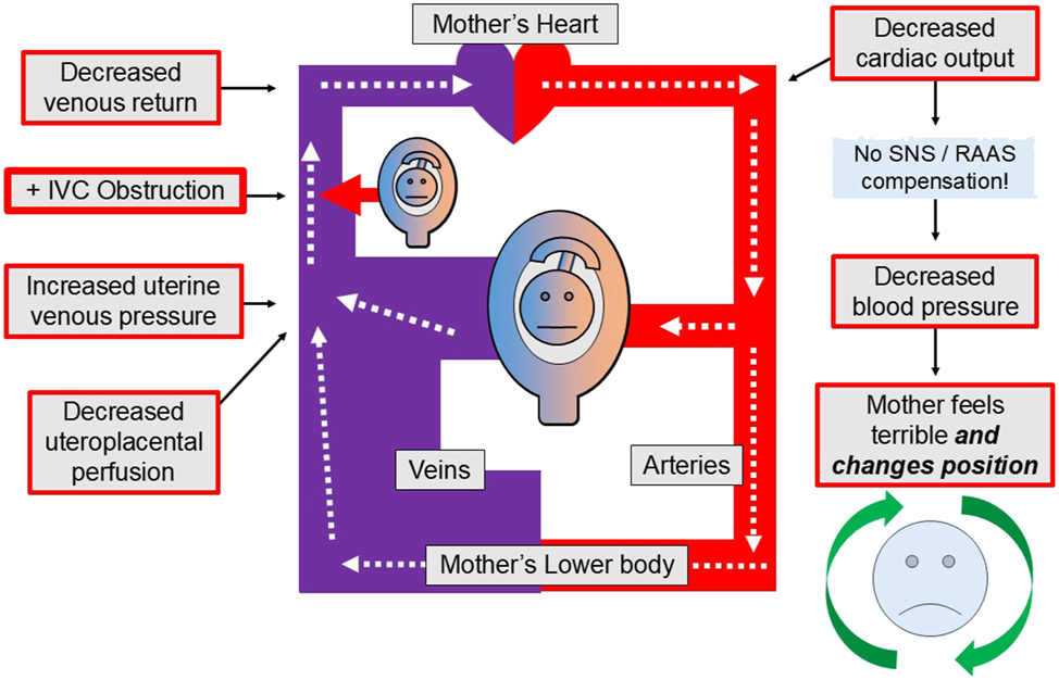 Figure 2: 
The maternal circulation during the “supine hypotensive syndrome of pregnancy”. The supine hypotensive syndrome of pregnancy occurs when the uterus obstructs maternal venous return and reduces maternal cardiac output and blood pressure. As a result, the pregnant woman experiences severe hypotensive symptoms or signs, such as light-headedness, nausea, vomiting, loss of consciousness or even death. But the original description of this syndrome did not consider the possible effects of this complex and unfavorable hemodynamic situation on the fetus, placenta or myometrium that would occur if some of those effects were allowed to persist for longer than a few minutes. Ironically – and fortunately – the supine hypotensive syndrome probably protects the fetus since it forces the mother (or her caregivers) to quickly change her body position, which then restores her normal venous return, cardiac output and blood pressure. The fetus, placenta and myometrium also benefit, of course, because their adequate oxygenation is promptly restored along with the mother’s circulation. The curved green arrows surrounding the mother’s blue face in the lower right-hand corner suggests this fortunate position change, which then produces recovery for both the mother and the fetus. Also, note that the supine hypotensive syndrome of pregnancy is theorized to occur because of a failure of the SNS and the RAAS to maintain normal blood pressure in the face of a decreased CO. This “fortunate failure” can be characterized as a lack of maternal cardiovascular compensation for a suddenly decreased BP. BP, arterial blood pressure; CO, cardiac output; IVC, inferior vena cava; SNS, sympathetic nervous system; RAAS, renin angiotensin aldosterone system.