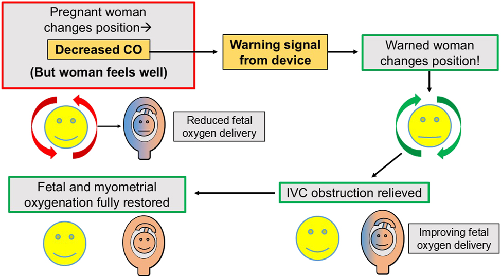 Figure 7: 
Cardiac output-guided maternal positioning: A positional decrease in maternal cardiac output serves as an actionable marker or warning signal for positional obstruction of maternal venous return. The idea of “cardiac output-guided maternal positioning” is to use positional decreases in maternal cardiac output to warn a pregnant woman – who may be feeling entirely comfortable – that her current body position may injure the fetus and to urge her to change her body position in order to restore a normal cardiac output with its associated low uterine venous pressure and optimal fetal oxygenation. It should be noted that the isolated beneficial effect of restoring maternal cardiac output per se to normal, may be difficult to determine in this scenario, since OUVR both decreases maternal CO and increases uterine venous pressure, and relief of OUVR by position change has the double benefit of both increasing maternal CO and decreasing uterine venous pressure. The important practical insight is that a positional decrease in maternal CO identifies an unfavorable hemodynamic situation which should be promptly corrected. This is the idea of cardiac output-guided maternal positioning. CO, cardiac output; OUVR, obstruction of uterine venous return.