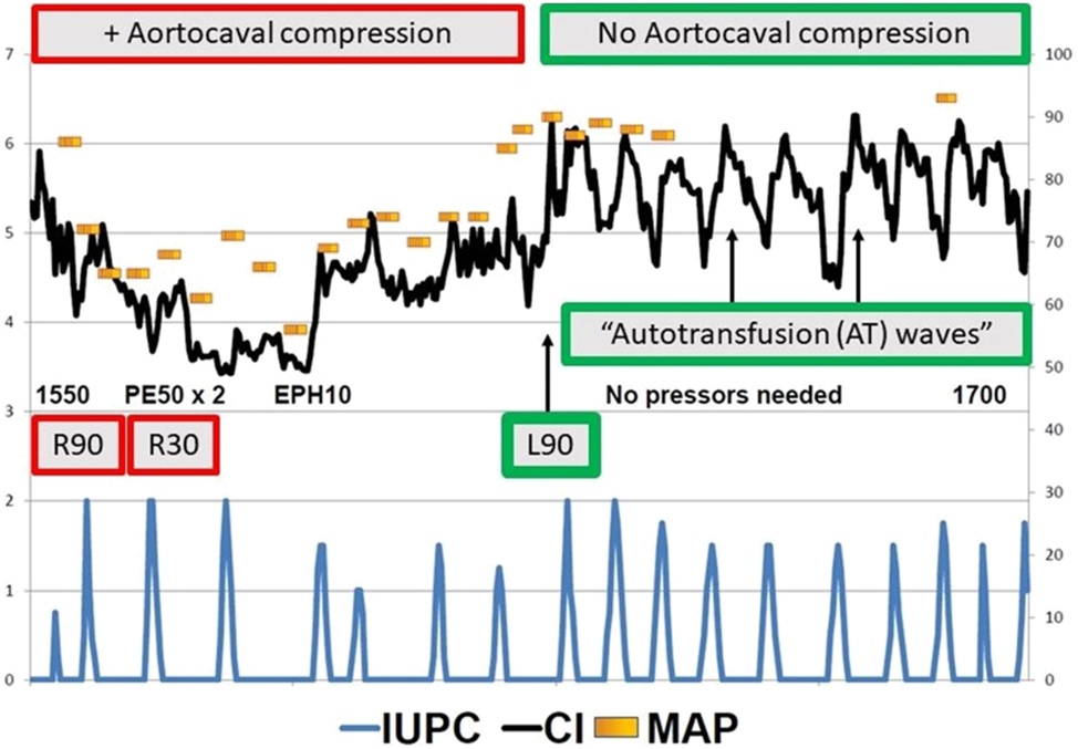 Figure 8: 
Trending maternal cardiac output during labor identifies favorable and unfavorable maternal body positions. This is a hemodynamic record from a preeclamptic patient in painful labor who has just received epidural analgesia for labor pain. Seventy minutes of data are shown, from 1550 until 1700. On the left side of the record, with the patient in right-side-down positions, the maternal blood pressure and cardiac output are low, and vasopressors are required to maintain adequate blood pressure. After turning the patient into the full left lateral decubitus position (at “L90”) the blood pressure and cardiac output increase without any need for vasopressors, and each uterine contraction is now accompanied by corresponding increases in maternal cardiac output due to autotransfusion in the presence of unobstructed uterine venous return. It should be noted that during this entire 70 min episode of care the fetal heart rate and variability were normal and the patient was comfortable once the epidural relieved her labor pain. These two facts suggest that the detection of a positional decrease in maternal cardiac output during labor can serve as an “early warning signal” prompting an immediate change in maternal position, which then preemptively avoids more overt and serious problems later on. Further research is required to determine whether this type of non-invasive hemodynamic monitoring during labor could reduce the incidence of “fetal distress,” dysfunctional labor with cesarean delivery and postpartum uterine atony and hemorrhage. Figure from [48], 50], 51]. AT, autotransfusion “waves” of increased maternal cardiac output; CI, cardiac index; EPH10 one dose of intravenous ephedrine 10 mg; IUPC, intrauterine pressure measured by intrauterine catheter; L90, patient turned into full left-lateral decubitus position; MAP, mean maternal arterial pressure; PE50 × 2, two intravenous doses of phenylephrine 50 mg; R30/R90, patient turned with right side down either 30 or 90° from supine; 1550, 3:50 PM; 1700, 5:00 PM.
