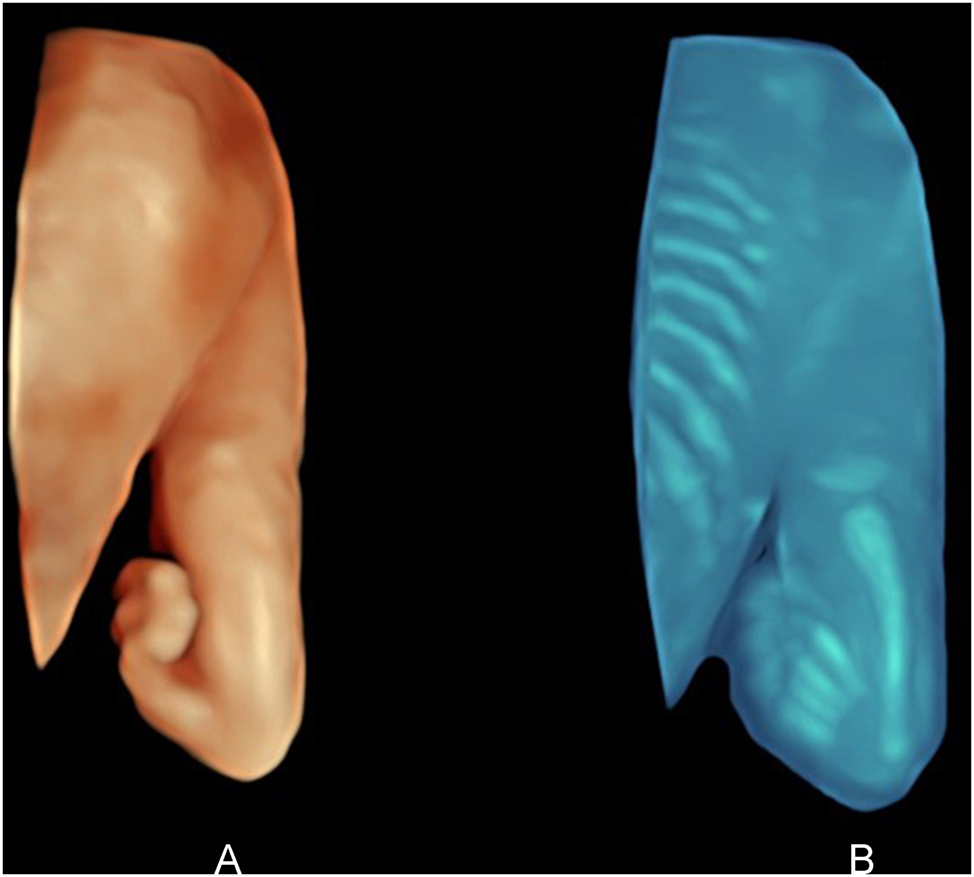 Figure 2:
(A) Dorsal surface view (HDlive) of hemimelia right with severe angulation of the hand with only four fingers. (B) The transparent view of the same arm reveals radius aplasia. 23 weeks’ gestation.