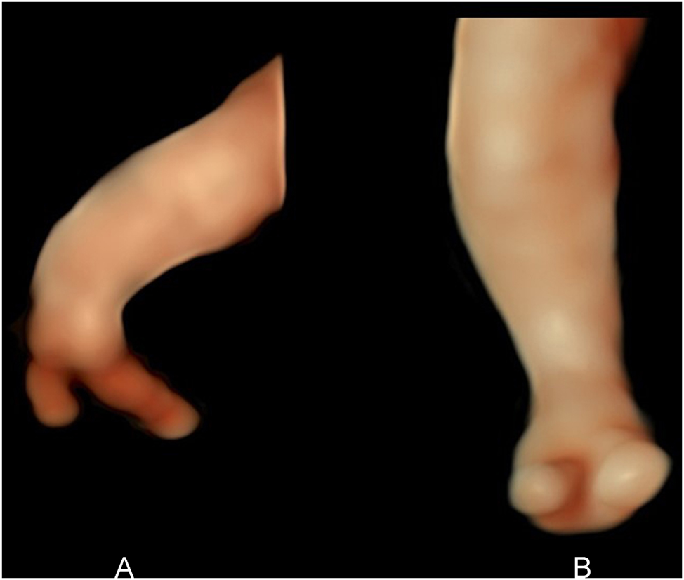 Figure 3:
(A) Surface view (HDlive) of ectrodactyly (split hand), showing only two fingers. 21 weeks’ gestation. (B) Frontal surface view (HDlive) of split foot with only two toes. 22 weeks’ gestation.