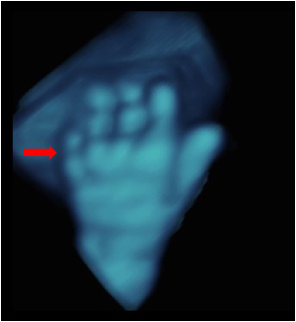 Figure 4:
Transparent view of the left hand from dorsal, demonstrating absent middle phalanx of digit 5 (red arrow), typical for trisomy 21. 22 weeks’ gestation.