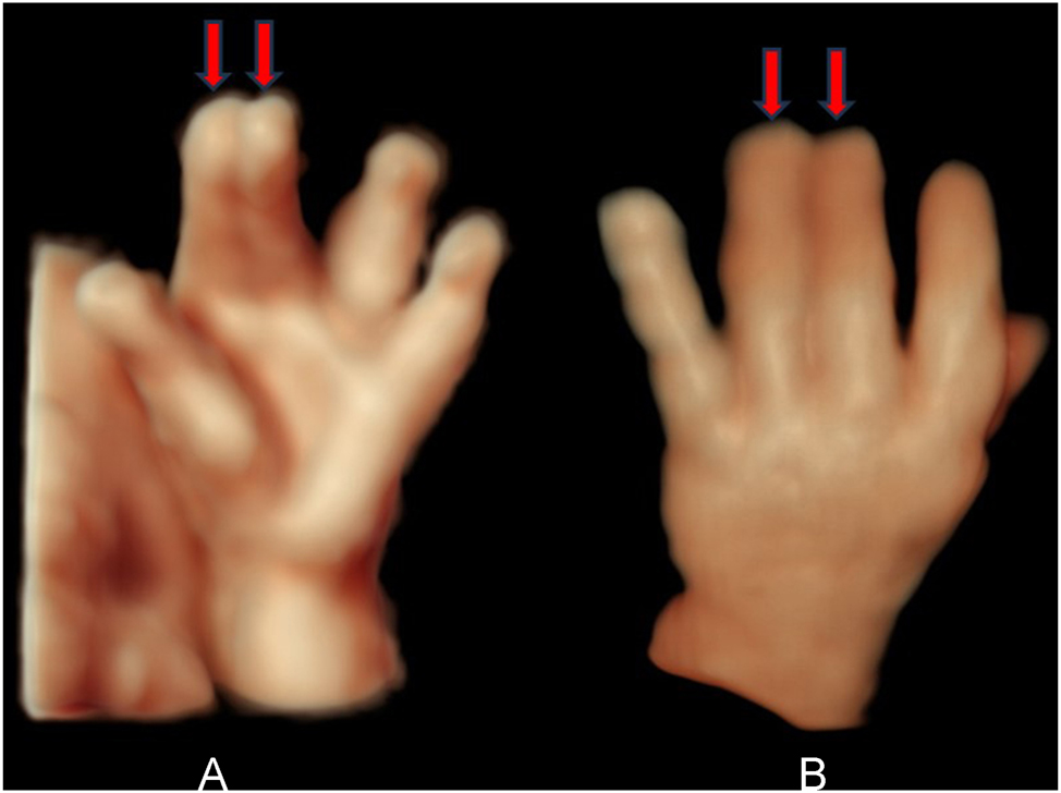 Figure 5:
(A) Frontal HDlive surface view of the left hand, showing complete syndactyly between digit 2 and 3 (red arrows). 23 weeks’ gestation. (B) Dorsal HDlive view of the left hand, showing complete syndactyly between digit 3 and 4. 35 weeks’ gestation (red arrows).