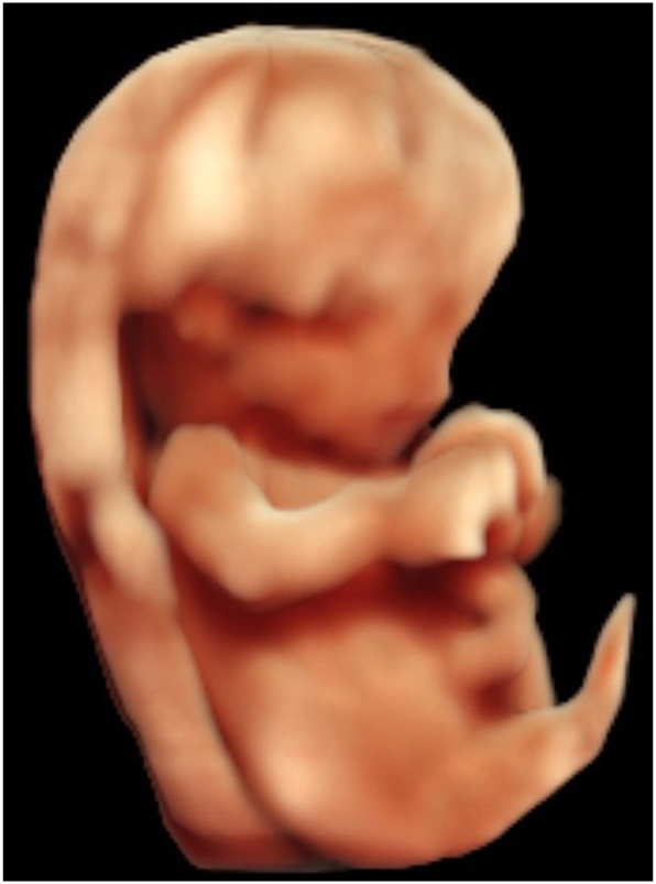 Figure 6:
HDlive surface view sirenomelia type VI, 14 weeks’ gestation.
