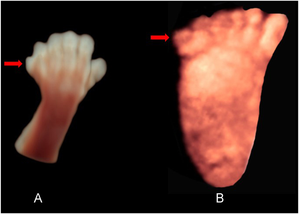 Figure 7:
(A) HDlive surface view of the left hand, showing postaxial hexadactyly (red arrow). 13 weeks’ gestation. (B) Plantar surface view of the right foot with postaxial hexadactyly (red arrow). 23 weeks’ gestation.
