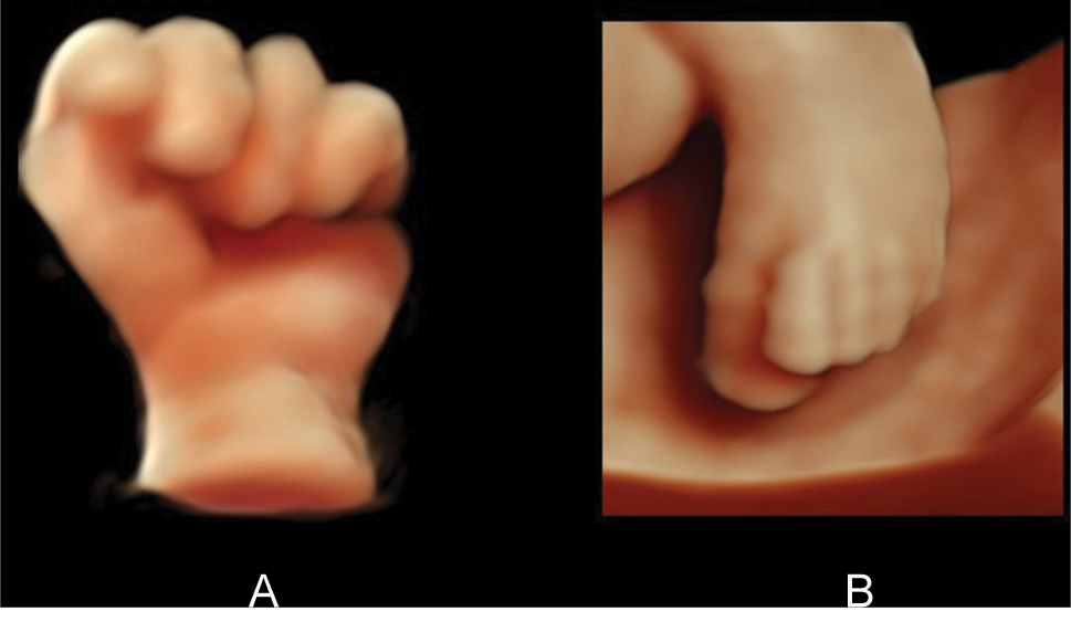 Figure 8:
(A) HDlive surface view of the left hand with overlapping of the index finger over the middle finger and the fifth finger over the ring finger, characteristic of trisomy 18. 31 weeks’ gestation. (B) HDlive surface view of the left foot with overlapping of the second toe over the first toe. 31 weeks’ gestation.
