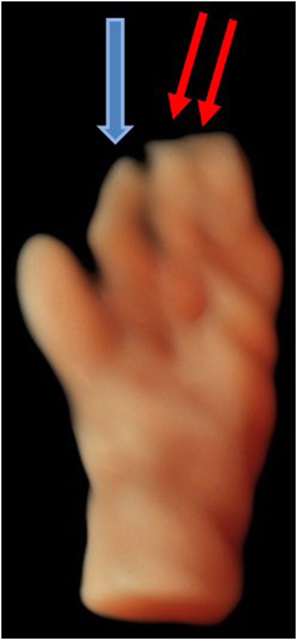 Figure 9:
HDlive surface view of the left hand with clinodactyly (index finger) (blue arrow) and syndactyly between finger 3 and 4 (red arrows). 18 weeks’ gestation.