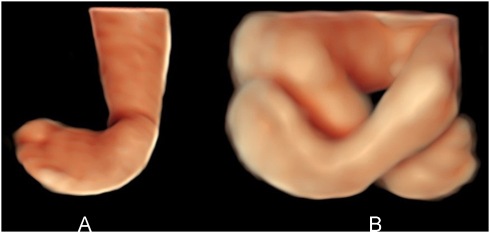 Figure 10:
(A) HDlive surface view of a unilateral clubfoot right (view from plantar). 21 weeks’ gestation. (B) HDlive surface view of bilateral clubfoot (frontal view). 19 weeks’ gestation.