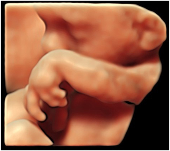 Figure 11:
HDlive surface view of the left hand with fixed position of the wrist and fingers, due to arthrogryposis multiplex congenita, 22 weeks’ gestation.