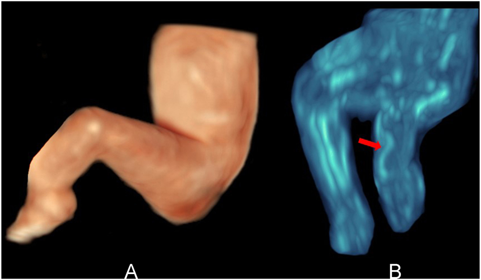 Figure 12:
(A) HDlive surface view of the left leg with bowing of the lower leg. 19 weeks’ gestation. (B) Transparent view of the same fetus, revealing bowing of tibia (red arrow) and aplasia of fibula. 19 weeks’ gestation.